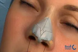 پرداخت هزینه عمل بینی اقساطی و دندانپزشکی قسطی