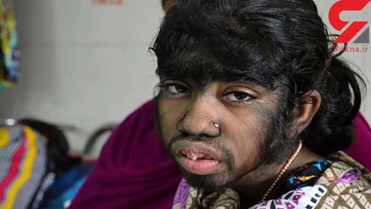 بیماری ناشناخته‌ ای این زنان را شبیه به هیولا کرد +تصاویر