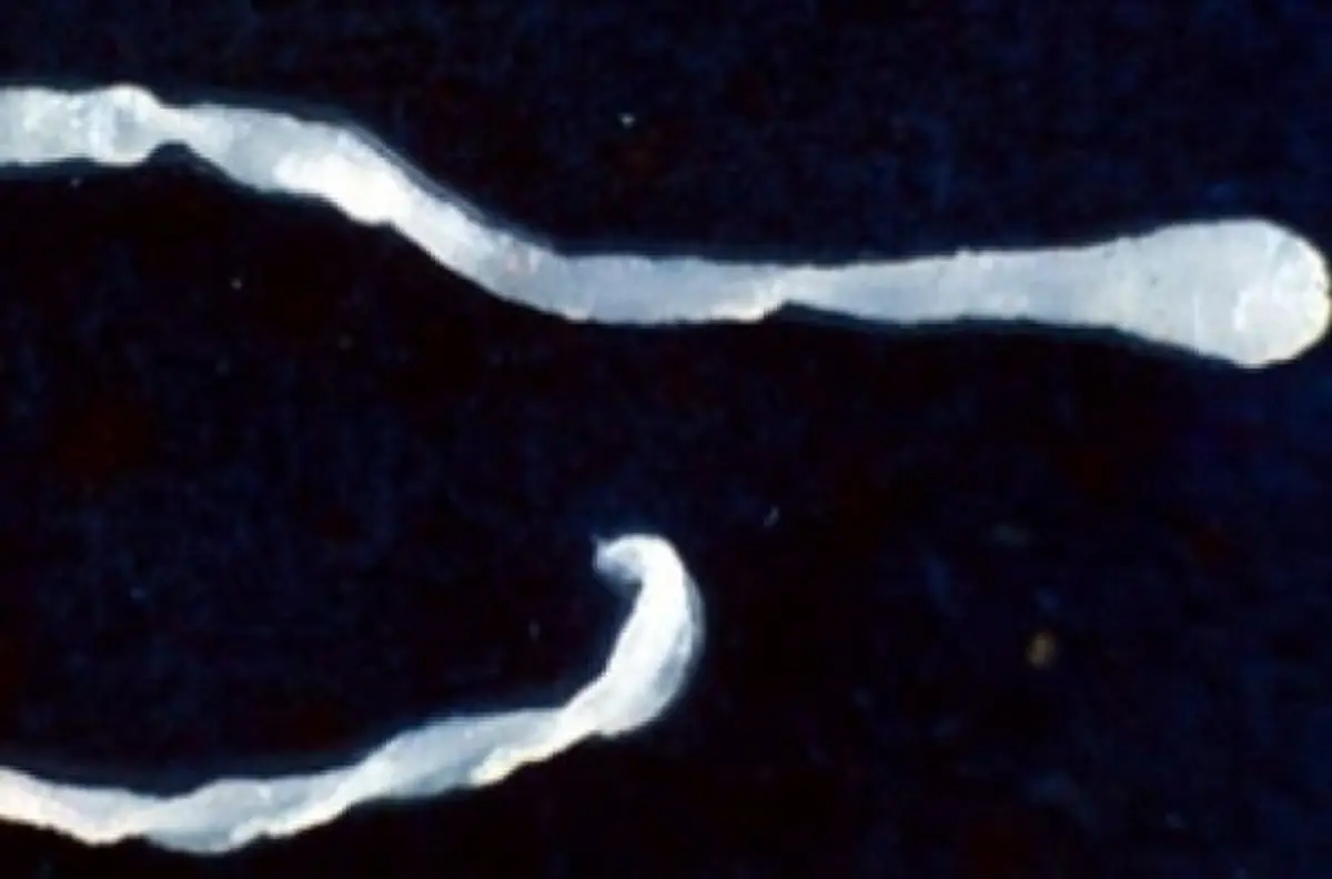 کرم 40 میلی‌متری در مغز یک مرد!/عکس