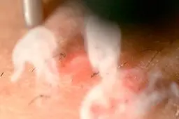 تصویر واقعی و وحشتناک لیزر درمانی روی پوست+ عکس