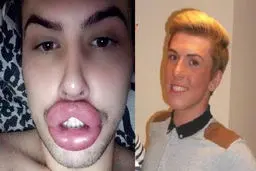 این پسر جوان با لب های شتری اش در دنیا معروف شد! + عکس