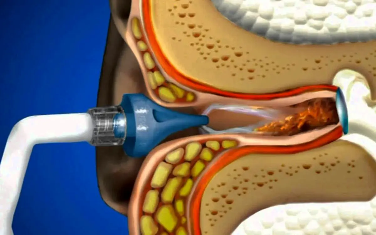 شستشوی گوش و خطرات احتمالی آن