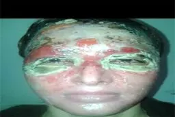 سزای پدری که به دخترش اسید پاشید+تصاویر