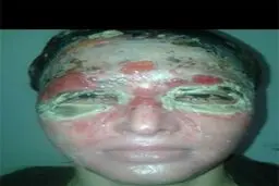 سزای پدری که به دخترش اسید پاشید+تصاویر