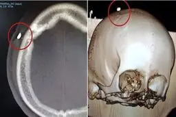 پزشکان از جمجمه بازیکن جوان یک دندان خارج کردند + عکس