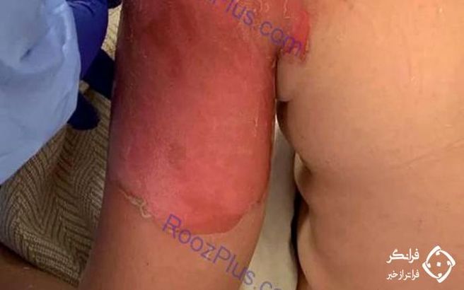 چالش آب جوش این بلا را سر جوان بازیگوش آورد + عکس 16+