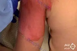 چالش آب جوش این بلا را سر جوان بازیگوش آورد + عکس 16+