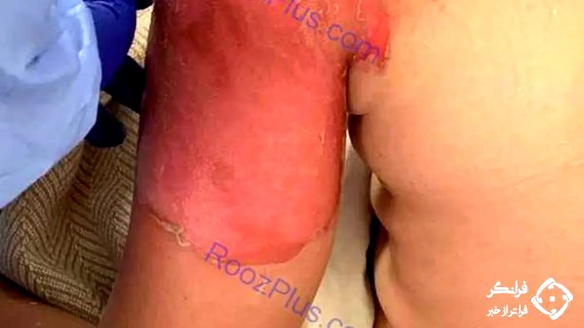 چالش آب جوش این بلا را سر جوان بازیگوش آورد + عکس 16+