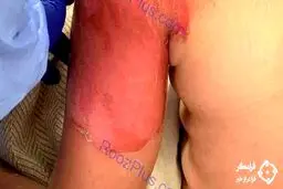 چالش آب جوش این بلا را سر جوان بازیگوش آورد + عکس 16+