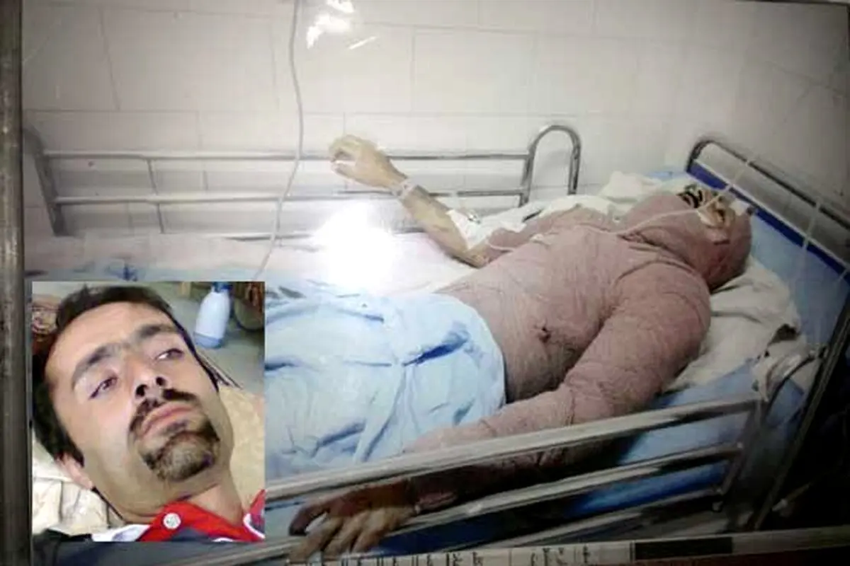 اسیدپاشی ​دو زن بر روی مرد جوان در هشترود+عکس