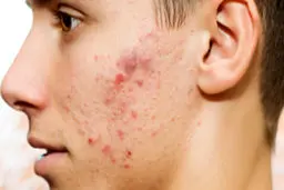 بهترین درمان های خانگی برای جوش صورت