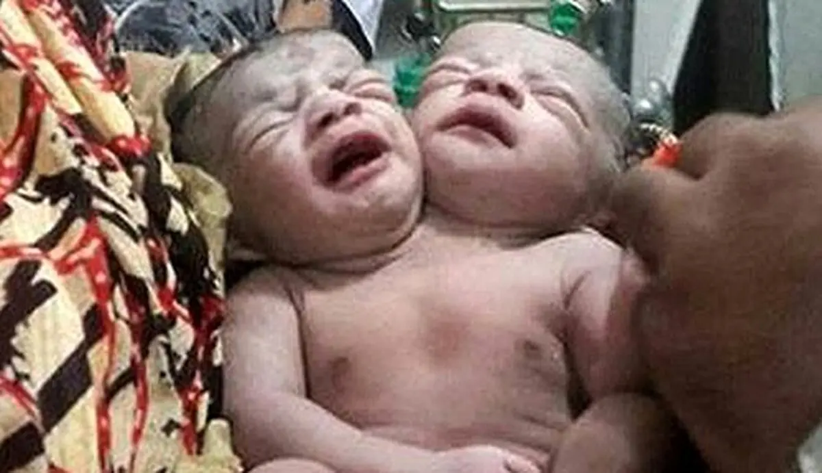 تجمع هزاران نفر از مردم بنگلادش برای دیدن نوزاد دو سر/ شیر خوردن با دو دهان و نفس کشیدن با دو بینی