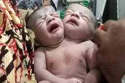 تجمع هزاران نفر از مردم بنگلادش برای دیدن نوزاد دو سر/ شیر خوردن با دو دهان و نفس کشیدن با دو بینی