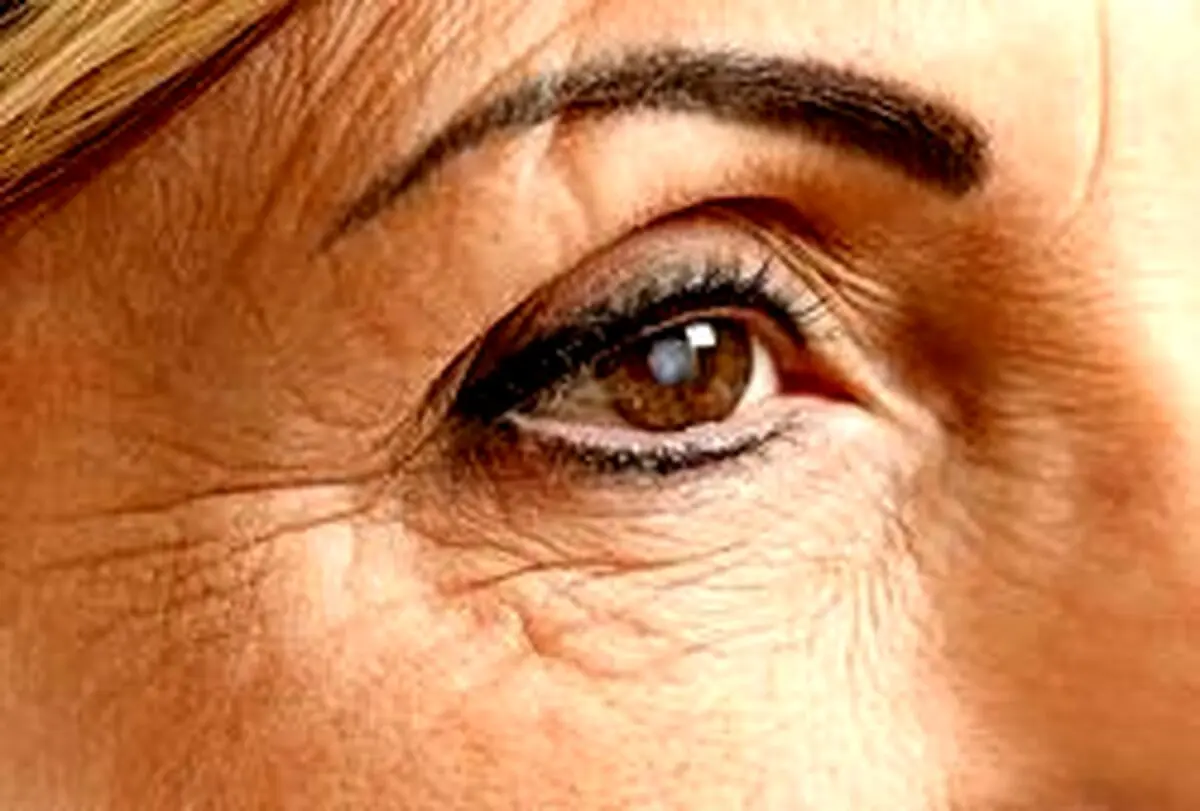 "سکته چشمی" ، علائم و خطرات