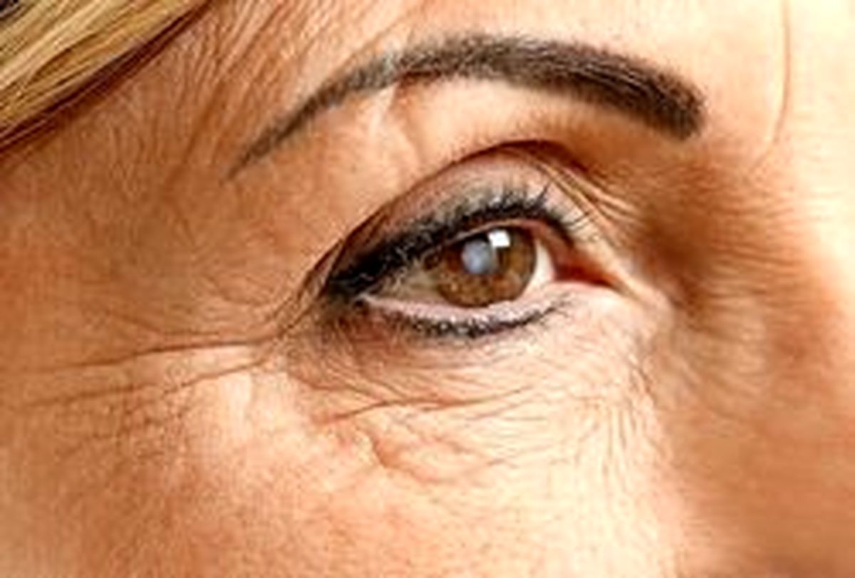 "سکته چشمی" ، علائم و خطرات