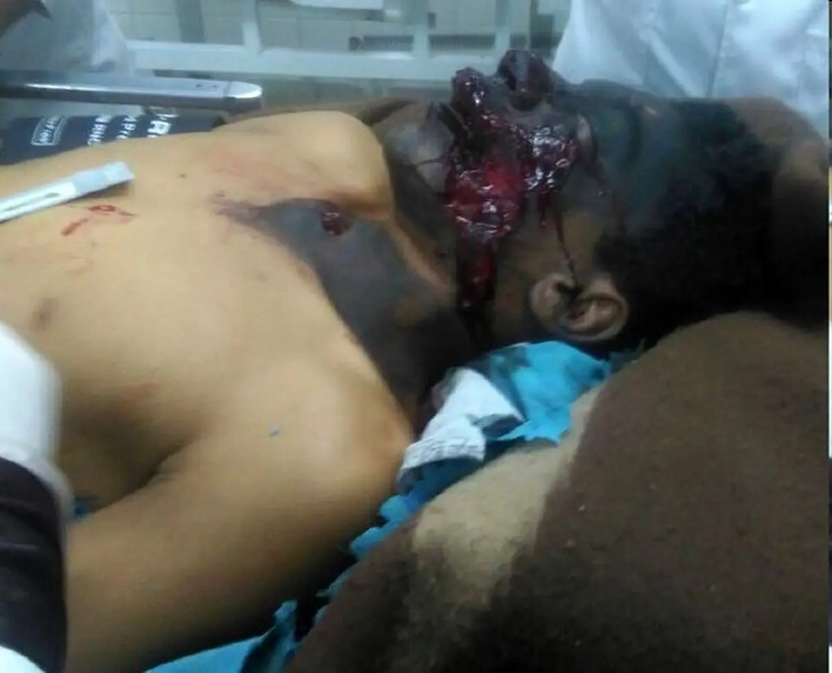 تصویری هولناک از سیاه شدن صورت نوجوان 13 ساله در اثر انفجار بمب