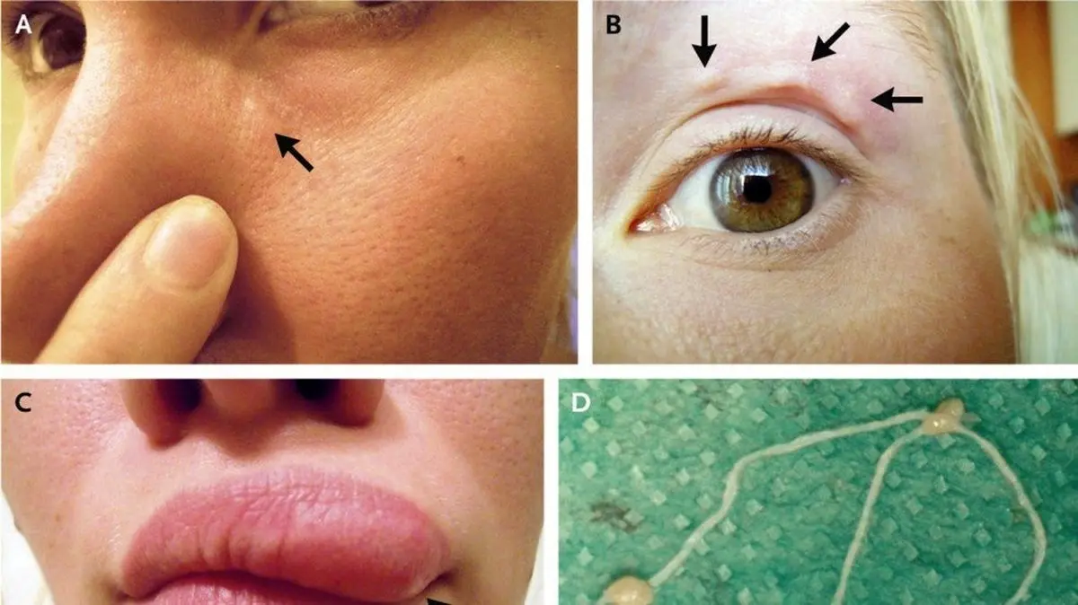 این زن هنگام سلفی گرفتن متوجه راه رفتن یک کرم زیر پوست خود شد! + عکس