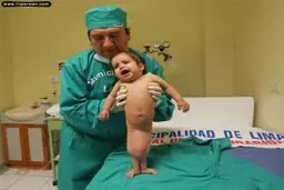 دختر مبتلا به سندرم پری دریایی درمان شد/عکس