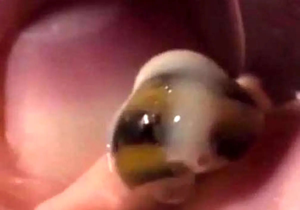 جانوری که زیر پوست یک پسربچه زندگی می‌کرد! + تصاویر