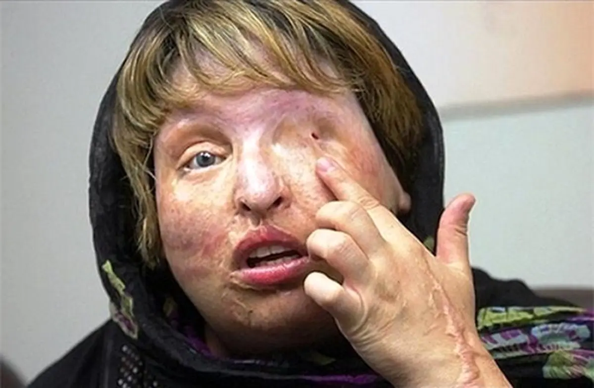 سابقه ۶۰ ساله جنایت اسیدپاشی در ایران/ از دلایلی نامعلوم تا قربانی‌ای که اشتباه گرفته شد