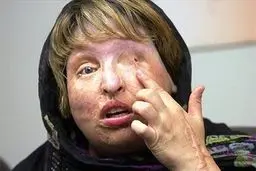 سابقه ۶۰ ساله جنایت اسیدپاشی در ایران/ از دلایلی نامعلوم تا قربانی‌ای که اشتباه گرفته شد