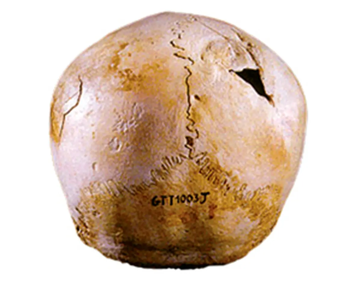 اولین جراحی مغز تاریخ/عکس