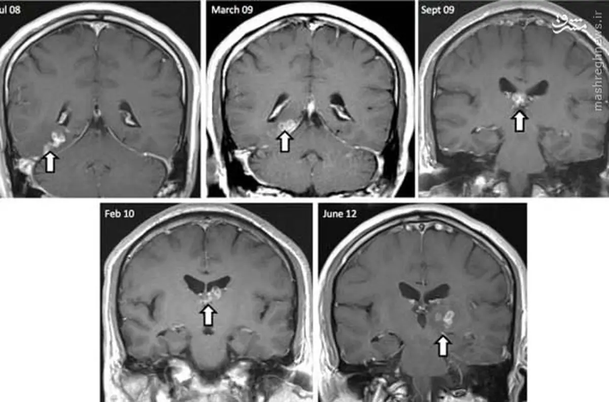 کشف‌کرم 4سانتی در مغز یک‌مرد+عکس