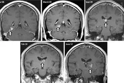 کشف‌کرم 4سانتی در مغز یک‌مرد+عکس