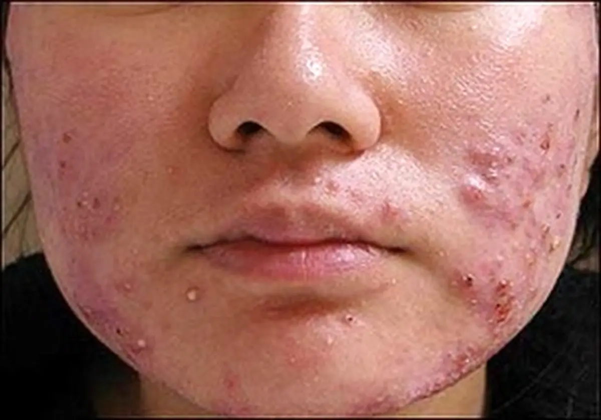 حقایقی درباره سندرومی مرموز که پشت جوش‌های صورت نهفته است