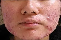 حقایقی درباره سندرومی مرموز که پشت جوش‌های صورت نهفته است