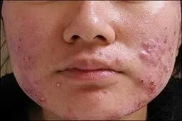 حقایقی درباره سندرومی مرموز که پشت جوش‌های صورت نهفته است